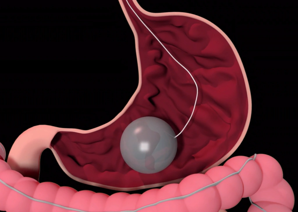 What is Gastric Balloon Surgery - CK Health Turkey
